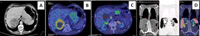 Case Report: Irreversible Watery Diarrhea, Severe Metabolic Acidosis, Hypokalemia and Achloridria Syndrome Related to Vasoactive Intestinal Peptide Secreting Malignant Pheochromocytoma